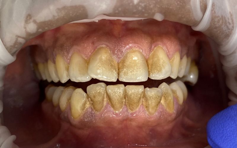 1-Before Oral Hygiene