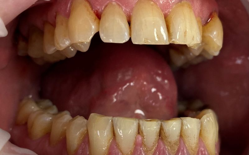 4-Before Oral Hygiene
